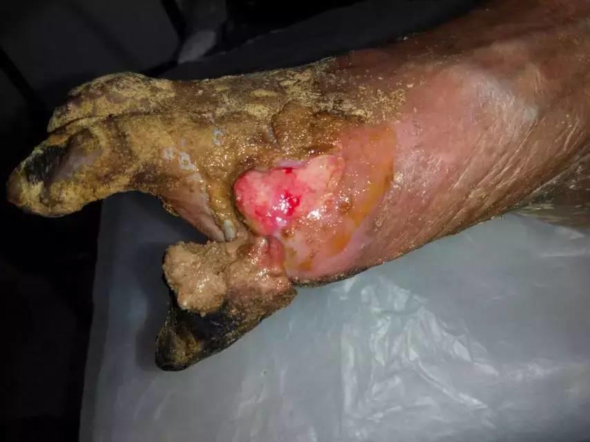 中國大陸“黑腳阿媽”感恩原始點讓她免遭截肢之苦