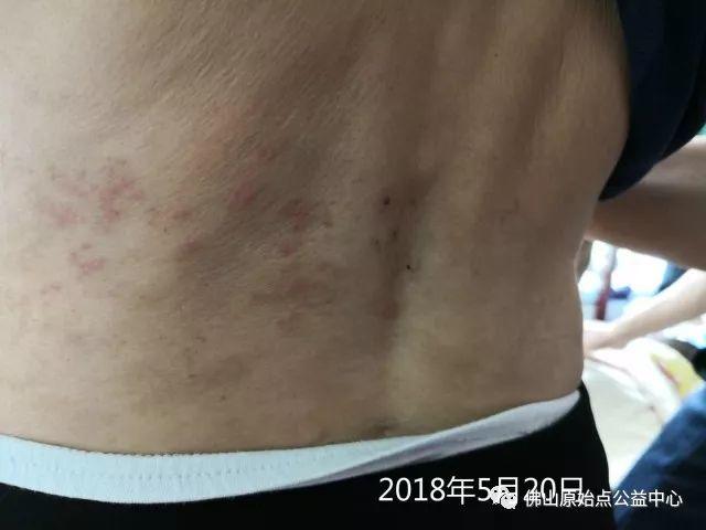 原始點調理帶狀皰疹：輕松快捷效果好