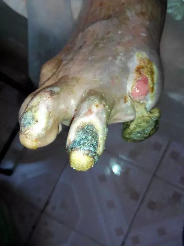 中國大陸“黑腳阿媽”感恩原始點讓她免遭截肢之苦