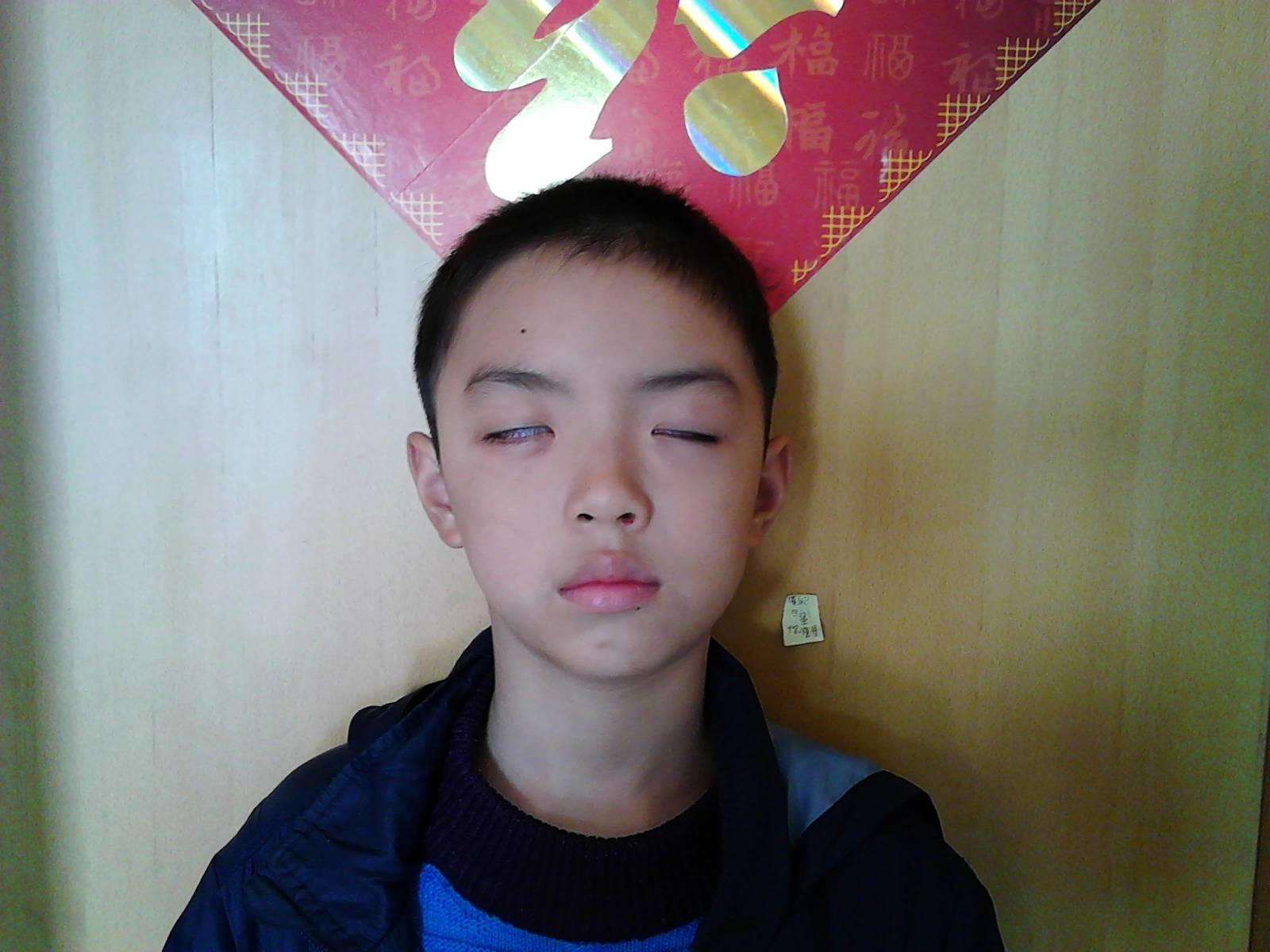 用原始點理療病毒性腦炎后遺癥三個月好了一大半