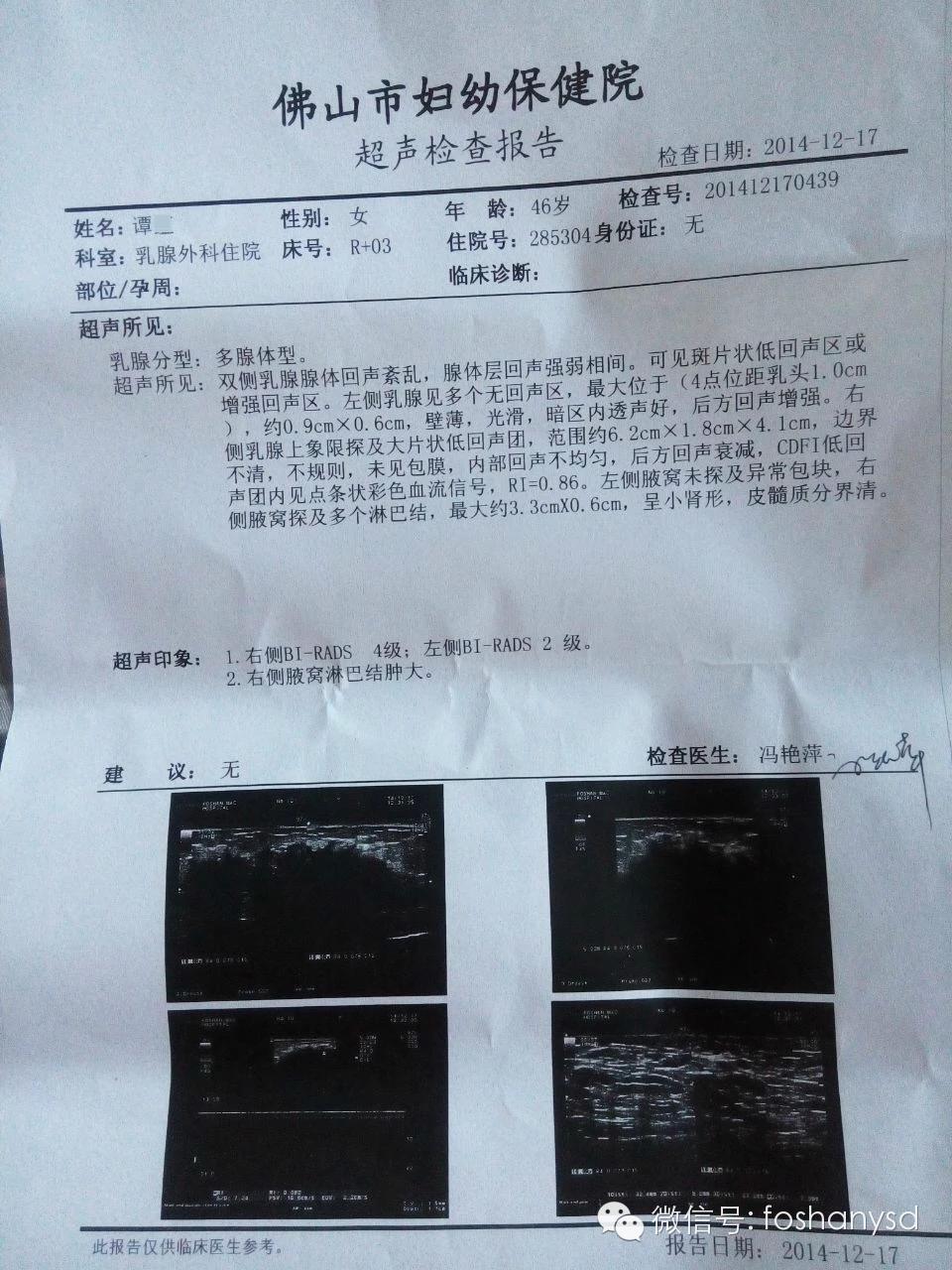 原始點調理乳腺癌三個月基本康復