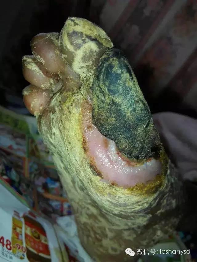 中國大陸“黑腳阿媽”感恩原始點讓她免遭截肢之苦