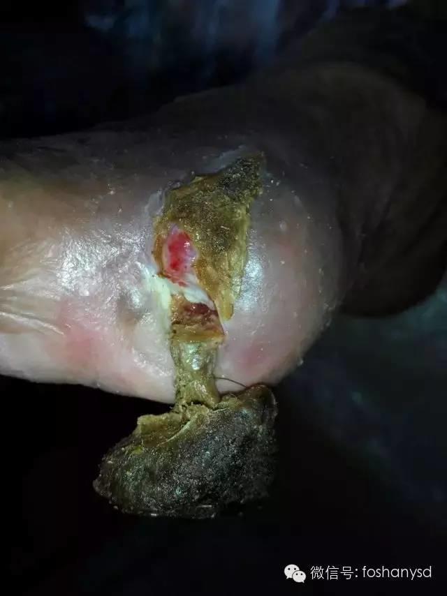中國大陸“黑腳阿媽”感恩原始點讓她免遭截肢之苦