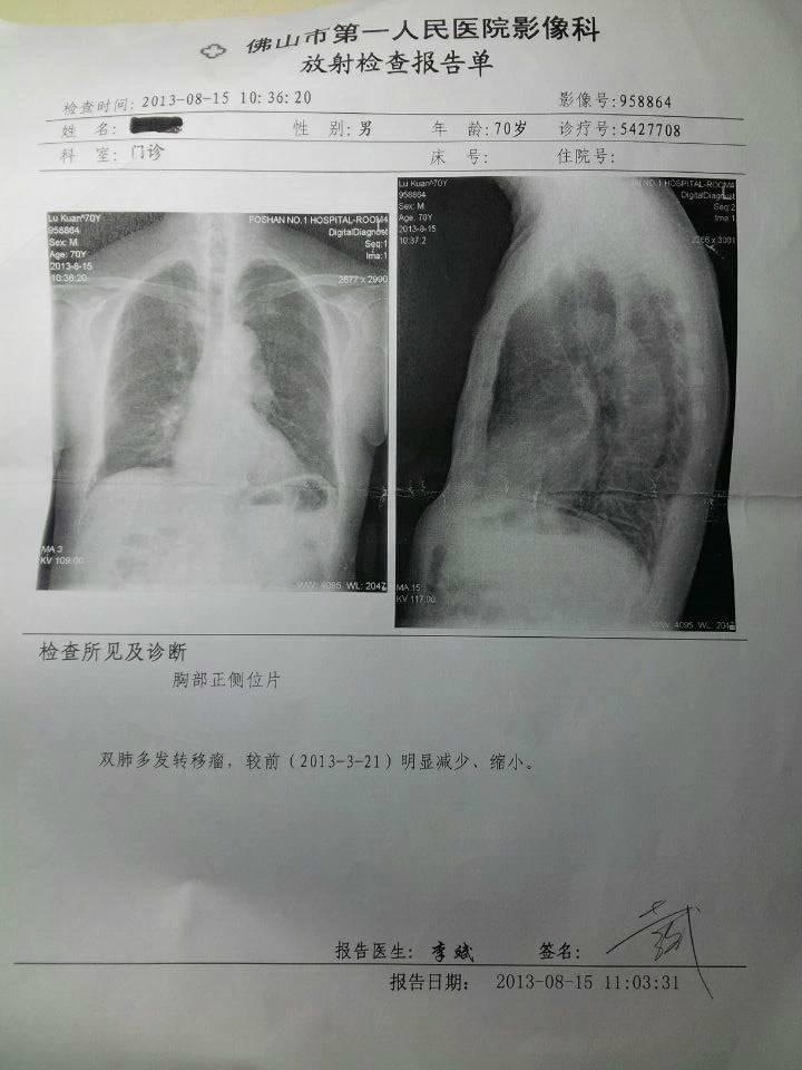 用原始點理療前列腺癌晚期一年身體恢復到正常狀態