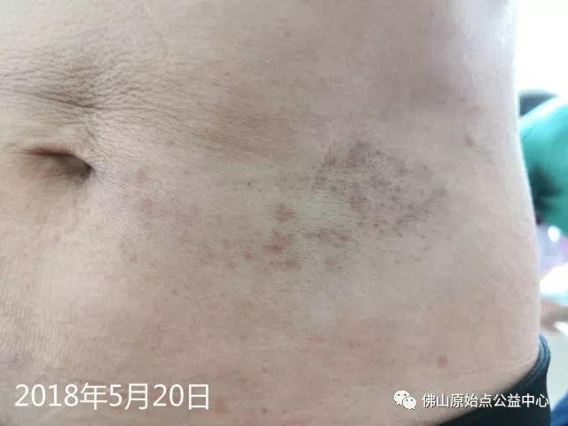 原始點調理帶狀皰疹：輕松快捷效果好