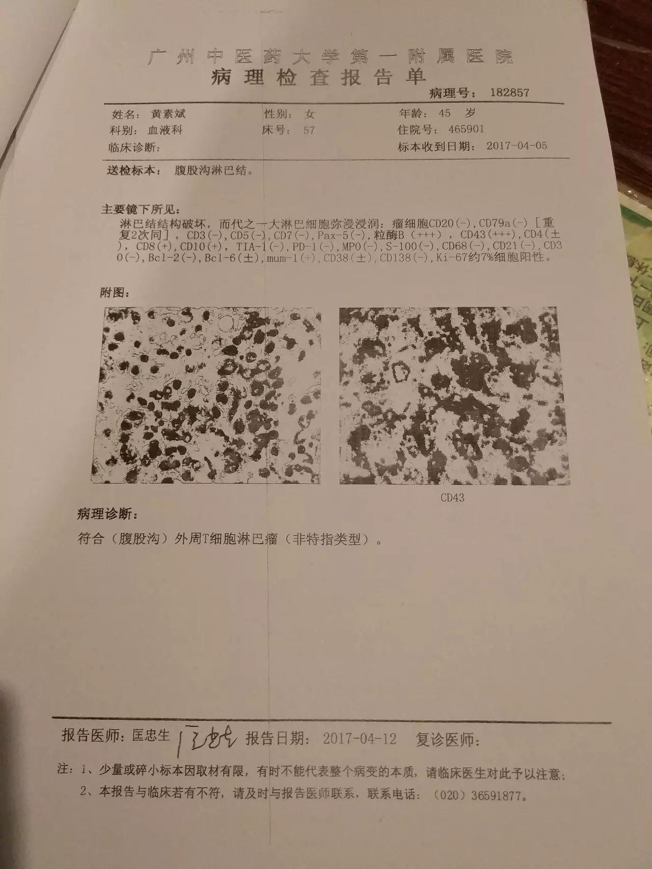 原始點調理淋巴瘤嚴重潰爛：無任何介入治療愈合