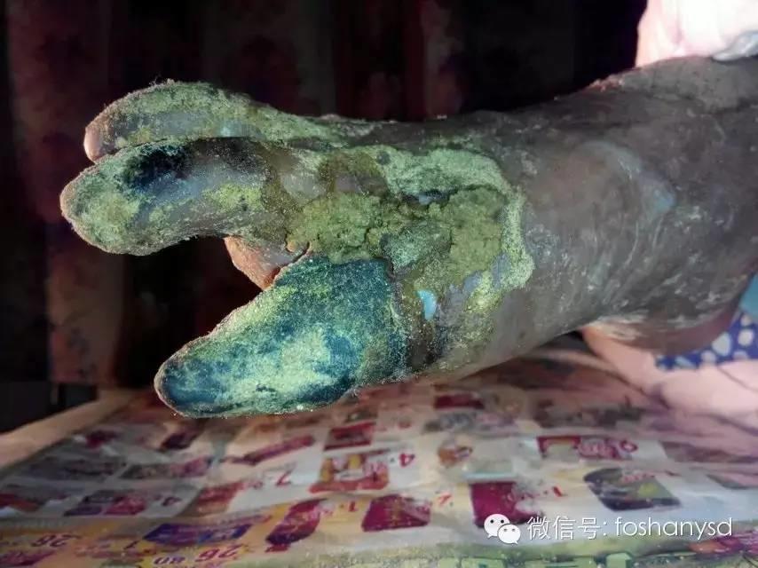 中國大陸“黑腳阿媽”感恩原始點讓她免遭截肢之苦