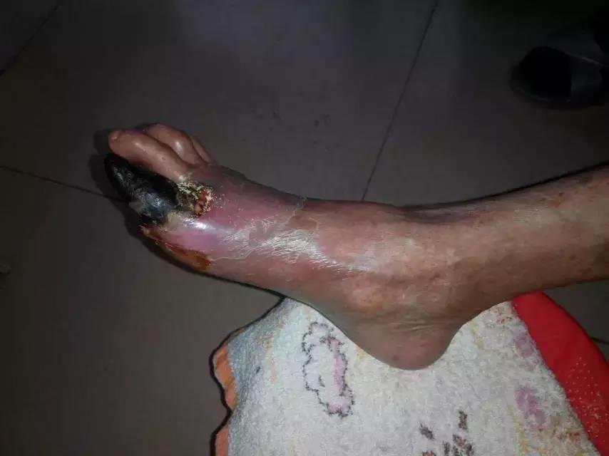 中國大陸“黑腳阿媽”感恩原始點讓她免遭截肢之苦