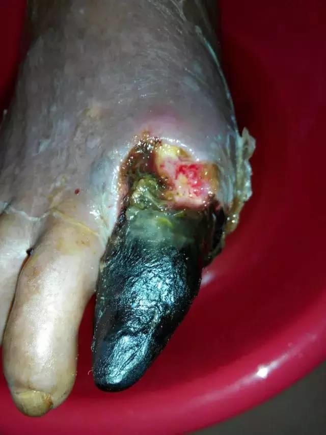 中國大陸“黑腳阿媽”感恩原始點讓她免遭截肢之苦