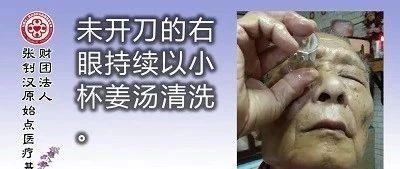 白內障姜湯洗眼案例-七不姜 生姜養生網-明德CSA生態姜園&明安農業