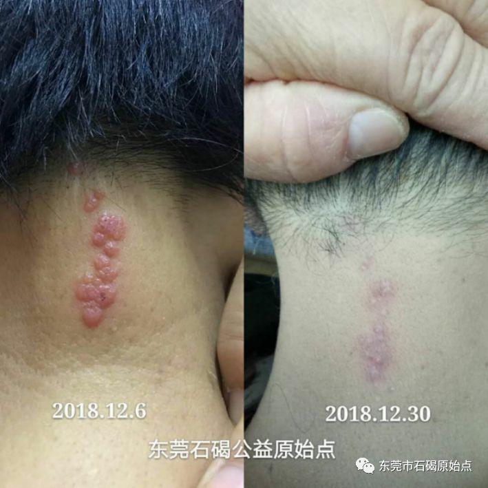 疑似帶狀泡疹 疑似帶狀泡疹
