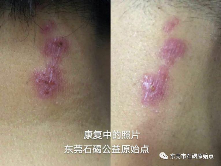 疑似帶狀泡疹