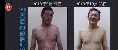 牛皮癬案例(馬來西亞)-七不姜 生姜養生網-明德CSA生態姜園&明安農業