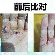 手部外傷案例-七不姜 生姜養生網-明德CSA生態姜園&明安農業