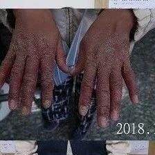 藥物中毒皮膚干癬案例-七不姜 生姜養生網-明德CSA生態姜園&明安農業