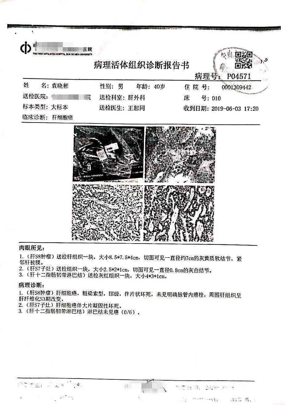 原始點調理肝腫瘤案例 原始點調理肝腫瘤案例
