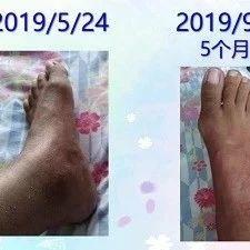 類風濕關節炎案例-七不姜 生姜養生網-明德CSA生態姜園&明安農業