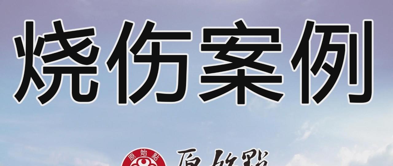 燒傷案例(簡)2019年11月-七不姜 生姜養生網-明德CSA生態姜園&明安農業