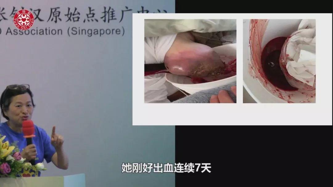 乳癌案例(2)-紅腫脹痛儲出血(紐約)