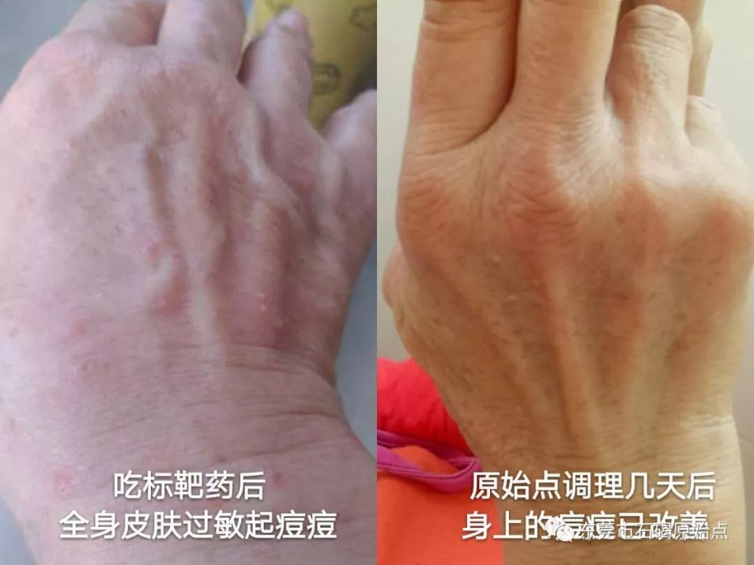 70歲鐘婆婆香港人晚期肺癌用原始點調理