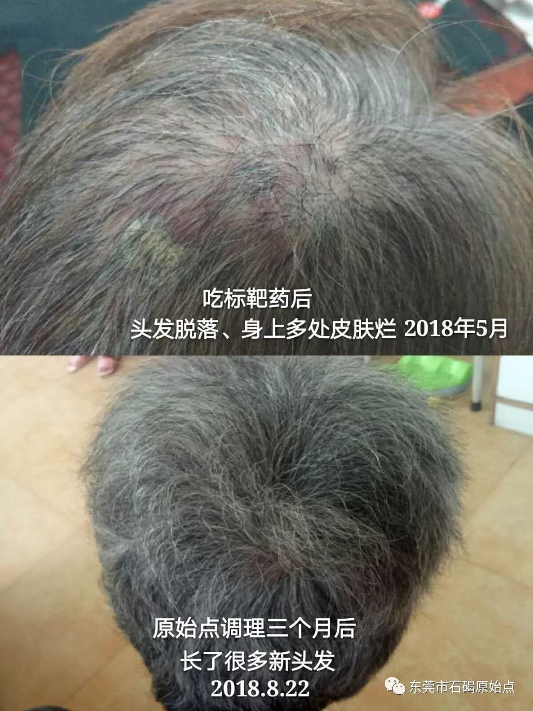 70歲鐘婆婆香港人晚期肺癌用原始點調理