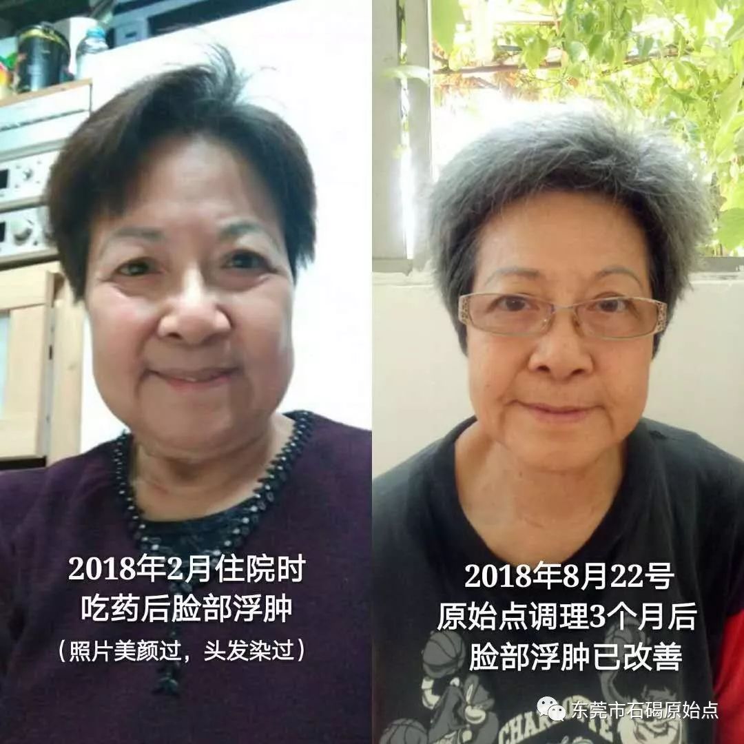 70歲鐘婆婆香港人晚期肺癌用原始點調理