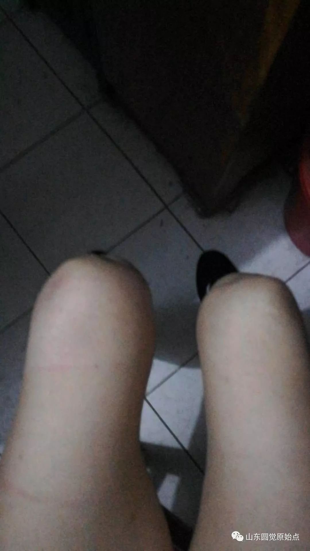 原始點案例：膝蓋腫脹