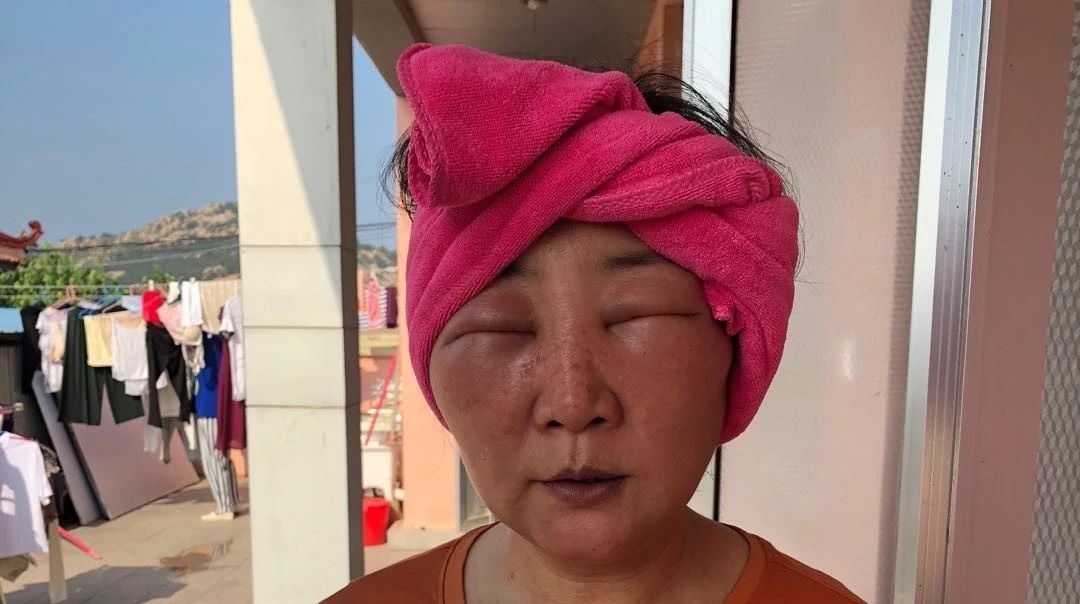 山東原始點案例:化妝品過敏臉部浮腫-七不姜 生姜養生網-明德CSA生態姜園&明安農業