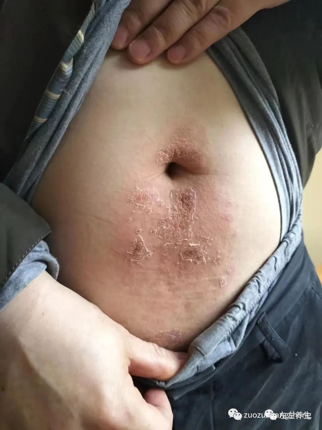 案例分享:腹部奇癢無比濕疹調理案例 案例分享:腹部奇癢無比濕疹調理案例