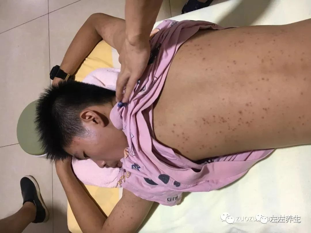 案例分享:14歲少年毛囊炎、全身癢、長痘痘的案例 案例分享:14歲少年毛囊炎、全身癢、長痘痘的案例