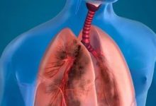 案例分享：71歲老人膀胱癌調理案例-七不姜 生姜養生網-明德CSA生態姜園&明安農業