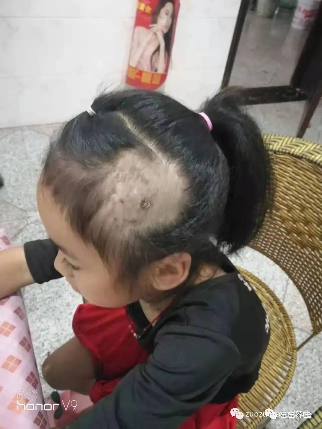 案例分享：小孩毛囊炎反復發作調理案例