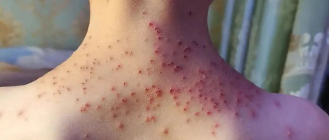 【原始點案例】原始點調理孩子水痘案例！-七不姜 生姜養生網-明德CSA生態姜園&明安農業