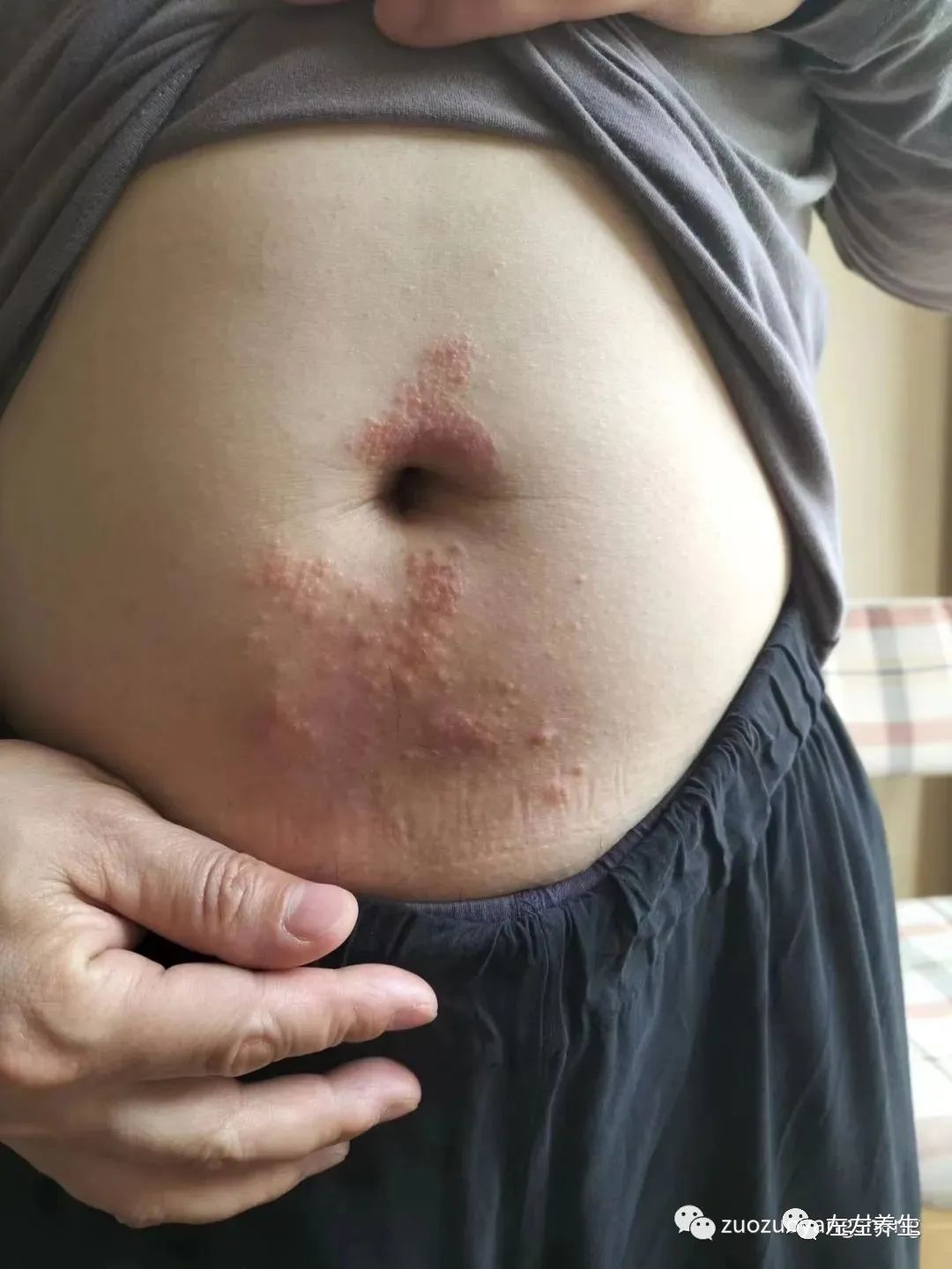 案例分享:腹部奇癢無比濕疹調理案例 案例分享:腹部奇癢無比濕疹調理案例