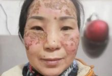 案例分享：臉上嚴重皮膚過敏調理案例-七不姜 生姜養生網-明德CSA生態姜園&明安農業