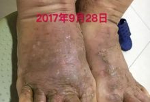 案例分享：全身奇癢無比的濕疹案例-七不姜 生姜養生網-明德CSA生態姜園&明安農業