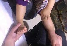 案例分享:原始點調理小孩蕁麻疹調理案例-七不姜 生姜養生網-明德CSA生態姜園&明安農業