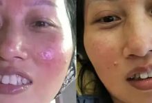 案例分享：臉上玫瑰痤瘡調理案例-七不姜 生姜養生網-明德CSA生態姜園&明安農業