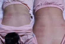 案例分享：20歲女孩脊柱嚴重側彎、盆骨突出、走路高低腳的案例-七不姜 生姜養生網-明德CSA生態姜園&明安農業