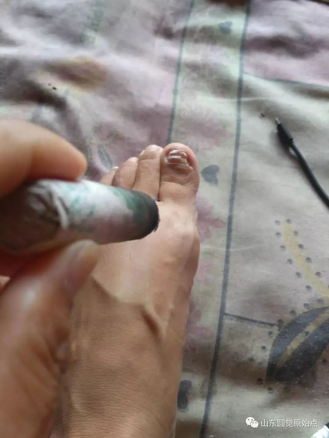 原始點案例：處理灰指甲