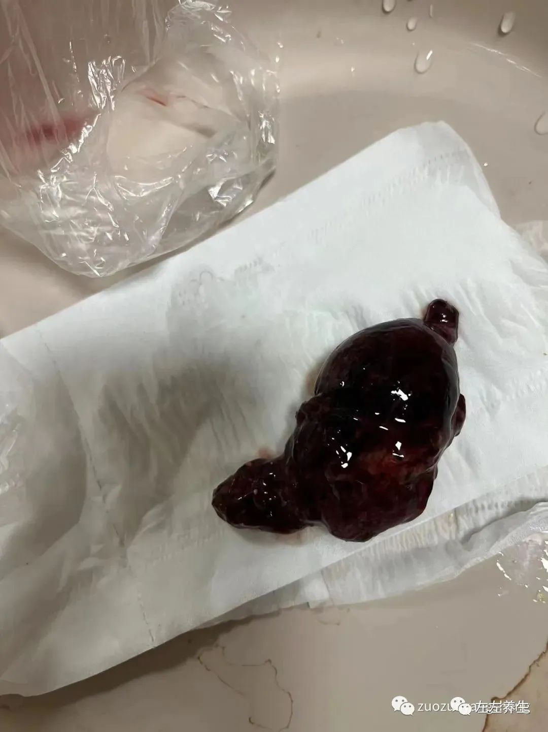 案例分享：胎停排死胎調理案例