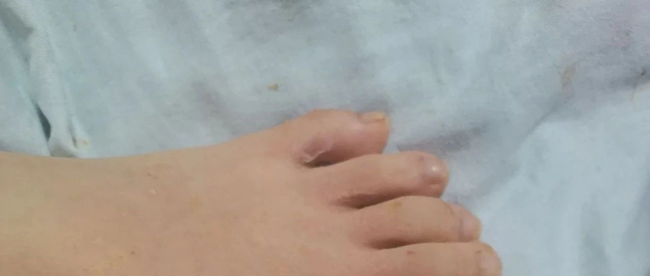 開水燙傷腳部 10歲男孩，2025年3月4號晚上洗腳時-七不姜 生姜養生網-明德CSA生態姜園&明安農業