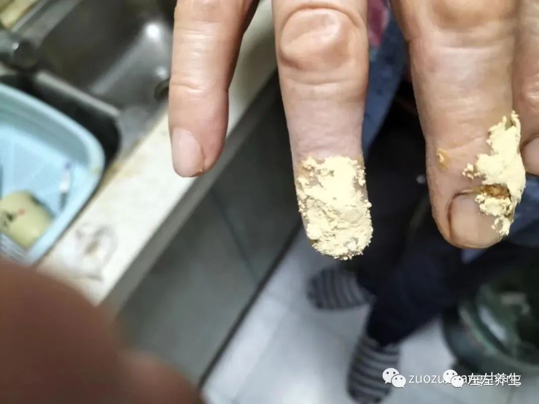 案例分享：手指夾傷后血流不止調理案例