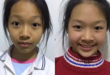 案例分享：兒童全身癢調理案例-七不姜 生姜養生網-明德CSA生態姜園&明安農業