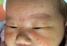 嬰幼兒濕疹怎么辦？（附手法視頻）-七不姜 生姜養生網-明德CSA生態姜園&明安農業