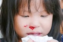 微問答283期：孩子頻繁流鼻血原始點如何處理？-七不姜 生姜養生網-明德CSA生態姜園&明安農業