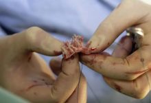 案例回訪：三年前那位沒去做心臟瓣膜置換術的女士情況怎么樣了？-七不姜 生姜養生網-明德CSA生態姜園&明安農業