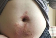 案例分享：腹部奇癢無比濕疹調理案例-七不姜 生姜養生網-明德CSA生態姜園&明安農業