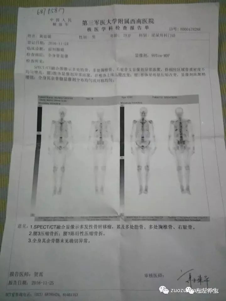 案例分享：前列腺癌的調理案例