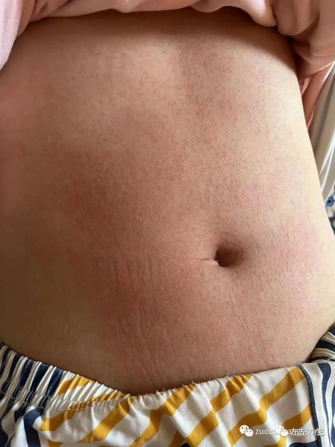 案例分享：胎停排死胎調理案例